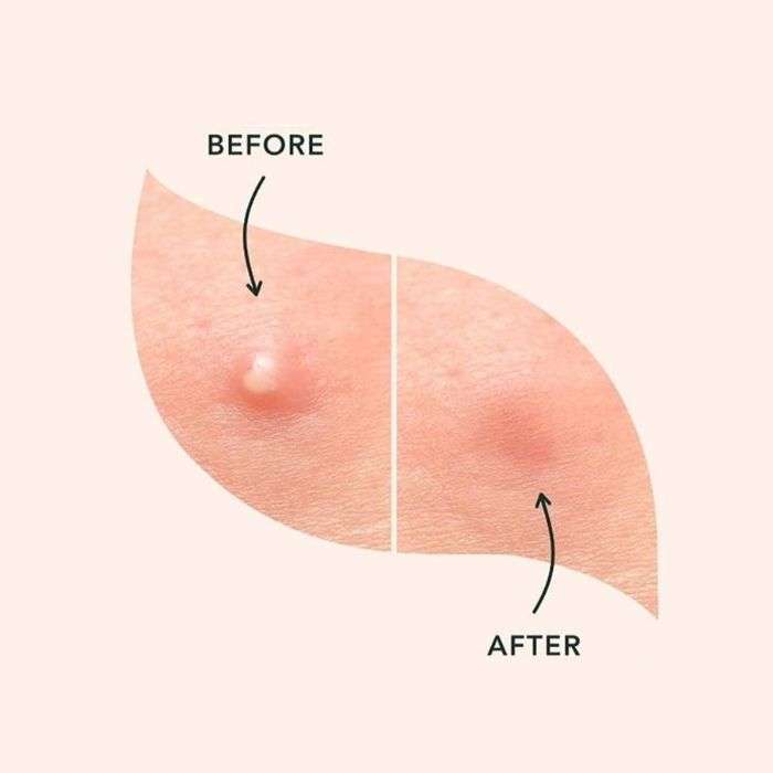 NODRAMA ACNE PATCHES 36 PATCHS 2 TAILLES